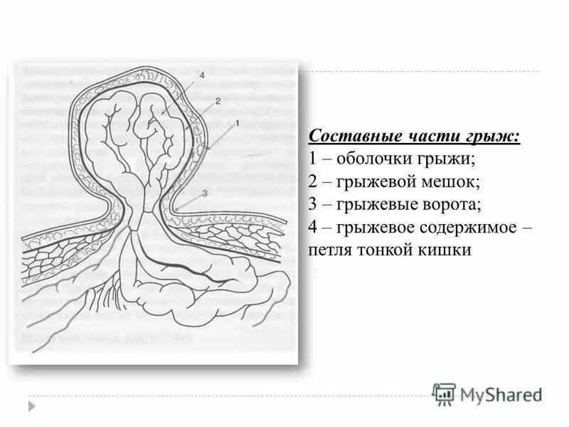 оболочки грыжи