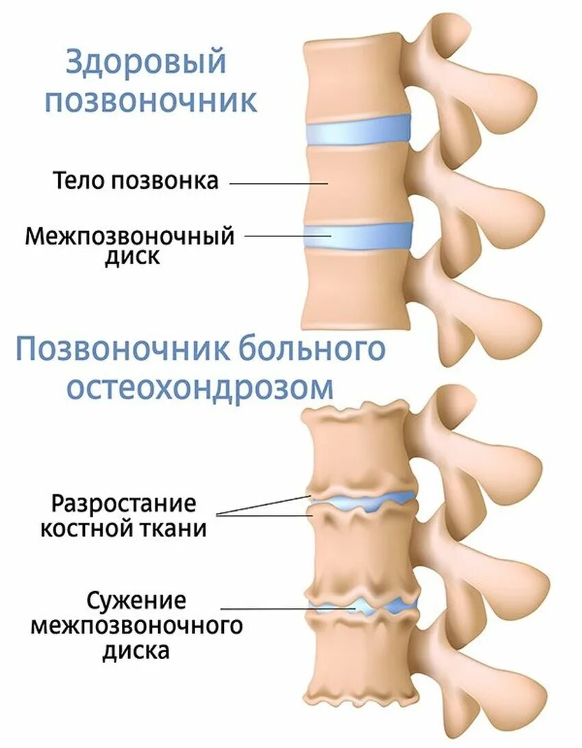 Остеохондроз позвоночника у взрослых шейного отдела. Спондилёз поясничного. Деформирующий спондилез. Спондилез позвоночника. Остеохондроз поясничного отдела 2 степени.