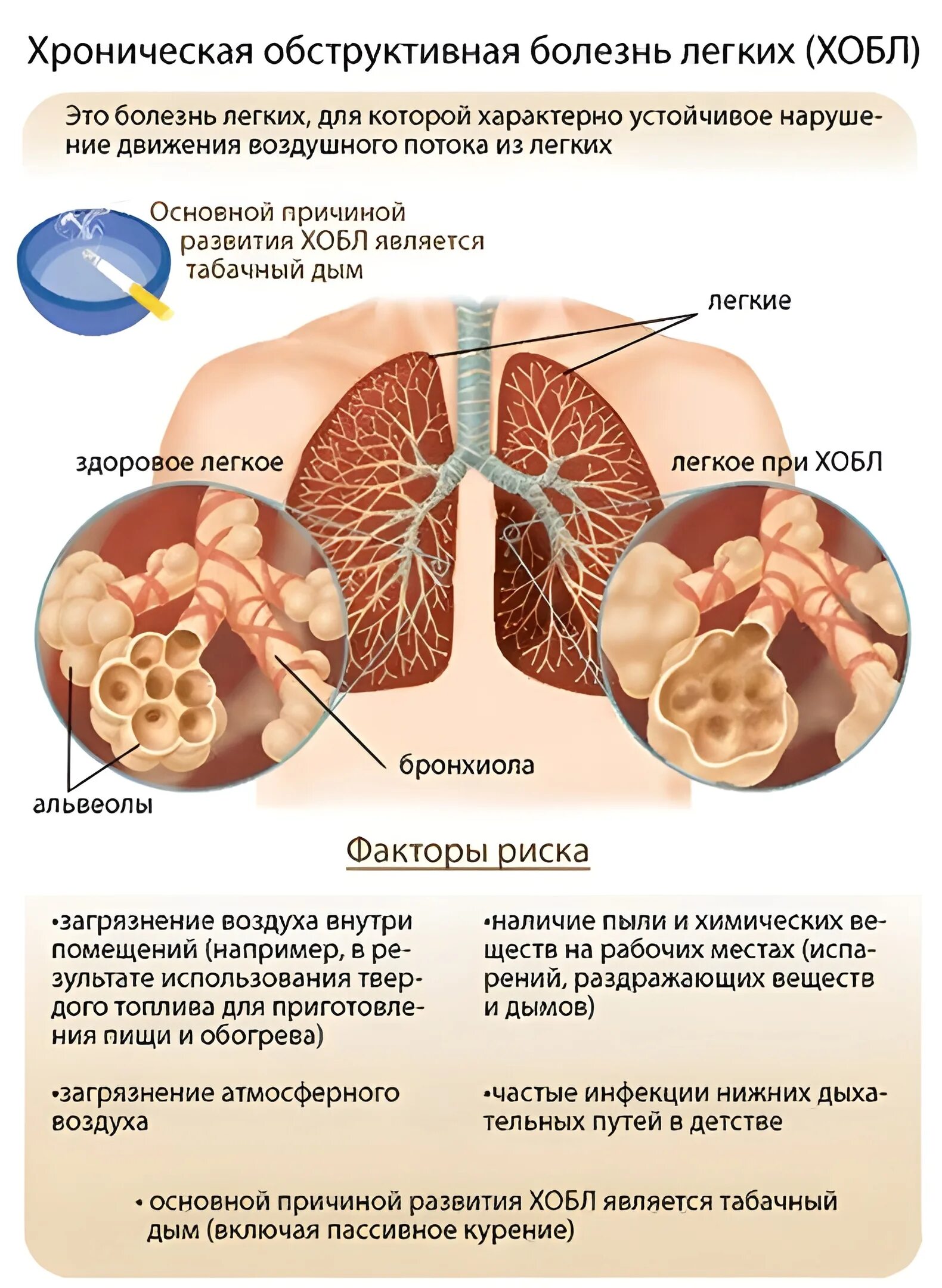 Опасное заболевание легких