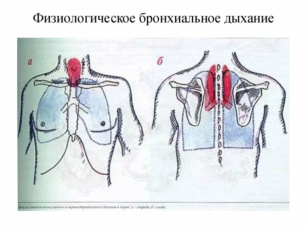 Аускультация везикулярного дыхания. Бронхиальное дыхание пропедевтика. Места выслушивания бронхиального дыхания. Бронхиальное дыхание аускультация. Ларинготрахеальное дыхание аускультация.