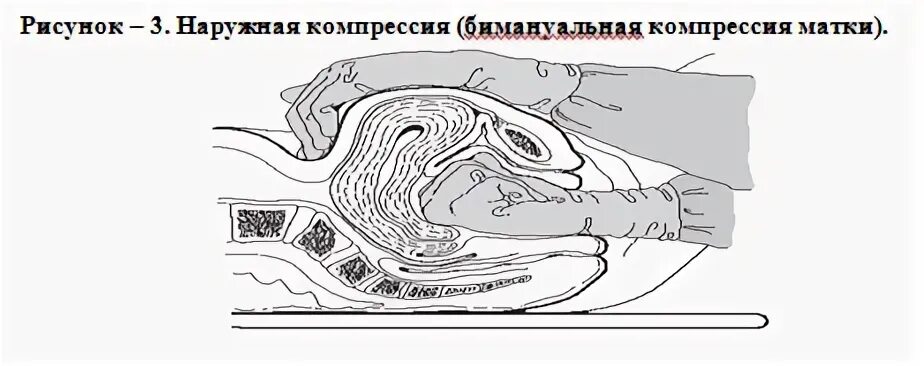 Наружный массаж матки алгоритм. Наружный массаж матки алгоритм