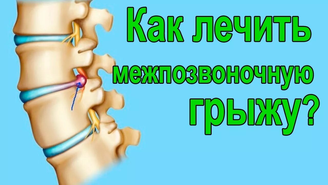 Можно вылечить грыжу позвоночника. Излечение межпозвоночной грыжи. как вылечить грыжу позвоночника. как вылечить грыжу позвоночника без операции в домашних условиях.
