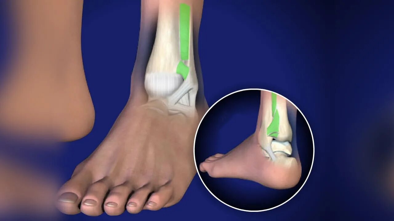 Синдесмоз голеностопного сустава. Растяжение синдесмоза голеностопного сустава. Операция на синдесмоз голеностопного сустава.