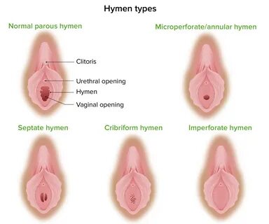 Types of hymen with pictures