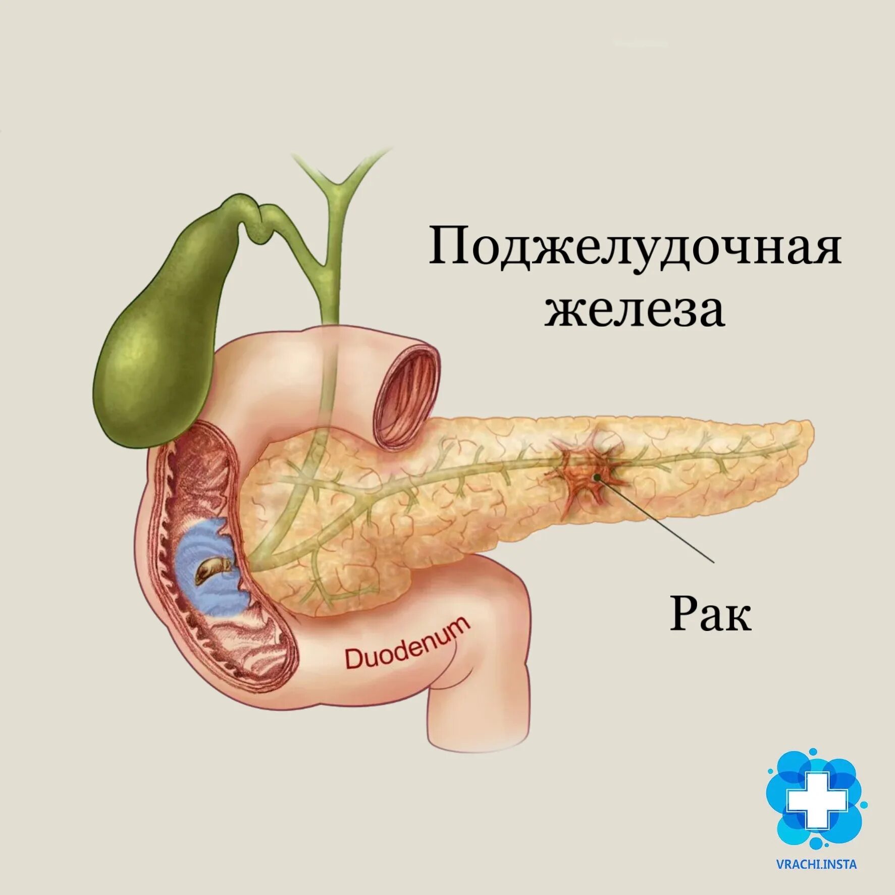Поджелудочная кома. Поджелудочная кома. Хронический панкреатит макропрепарат. Поджелудочная кома. Поджелудочная кома.
