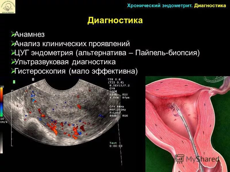 Какая матка при воспалении. Очаговый эндометриоз матки на УЗИ. Эндометриоз и гиперплазия эндометрия. Эндометрия эндометрит эндометриоз.