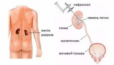 Удали почку