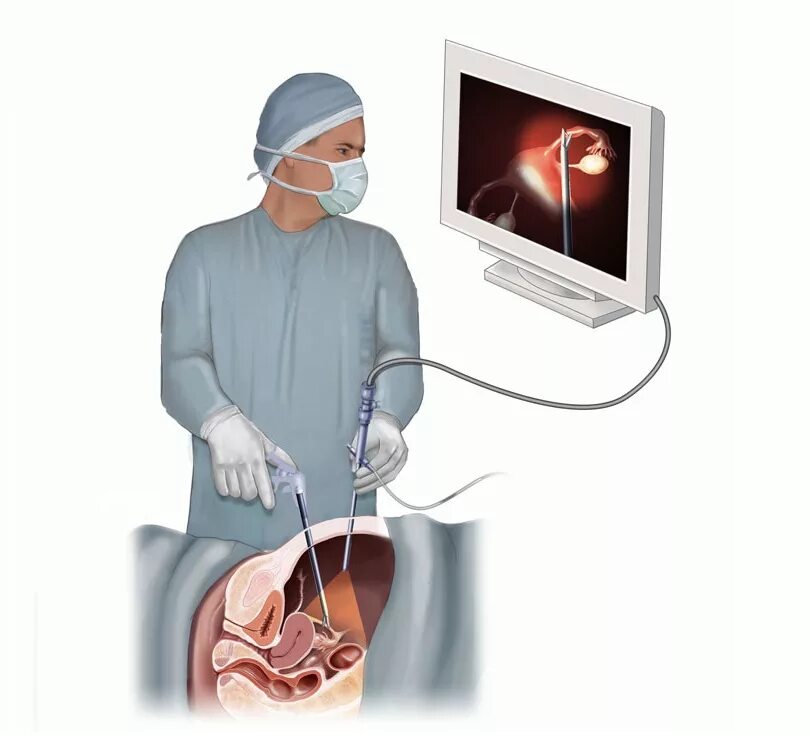 Внематочная беременность лапароскопия. Лапароскопические малоинвазивные операции. Лапароскопия брюшной полости. Операция внематочной беременности лапароскопии. Абдоминальная операция что это