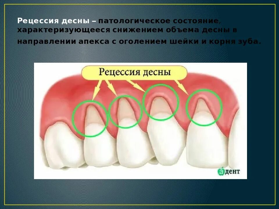 Рецессия десны фото - ViktoriaFoto.ru