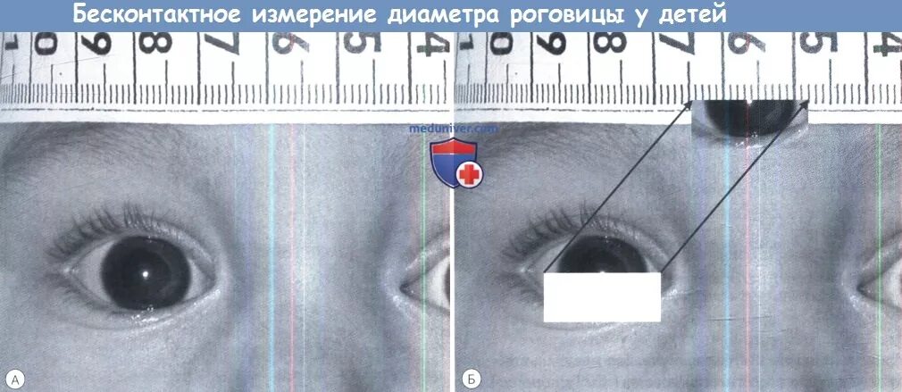 Норма роговицы. Измерение диаметра роговицы. диаметр роговицы в норме. размер роговицы у новорожденного. измерение толщины роговицы.