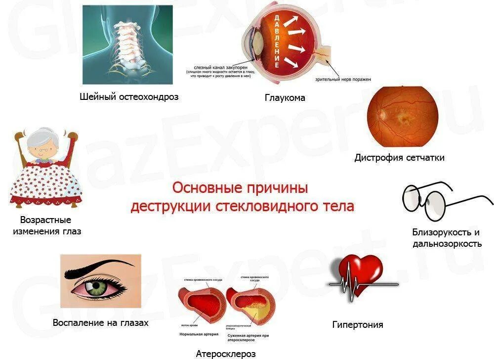 Деструкция стекловидного тела причины. Деструкция стекловидного тела симптомы. Нитчатая деструкция стекловидного тела глаза. Дестркуция стекловидногт ела.