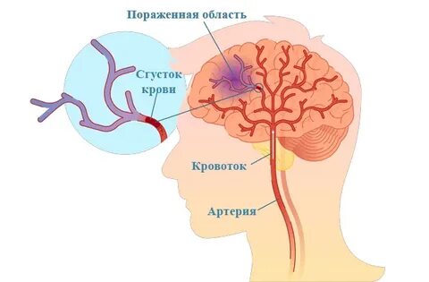 Моторная дисфазия