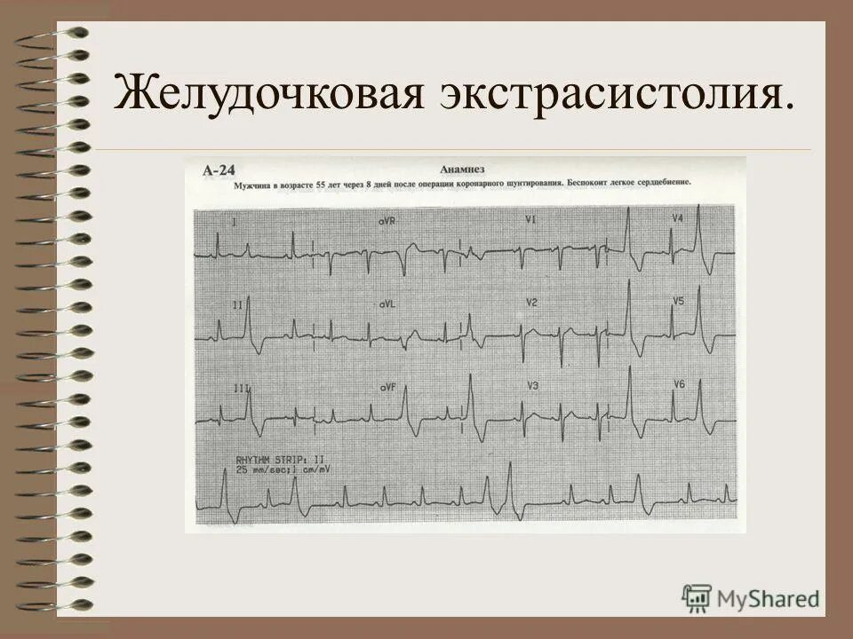 Типы желудочковых экстрасистол