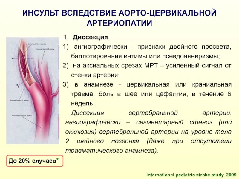 Диссекция вса. Диссекция церебральных артерий. диссекция шейных артерий. диссекция сонной артерии на узи. диссекция сонной артерии причины.