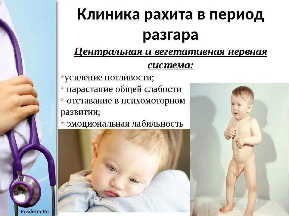 Ранние симптомы рахита у ребенка. Клиника начального периода рахита. Клиника рахита у новорожденных. Рахит 1 степени симптомы у новорожденных. 1 признаки рахита