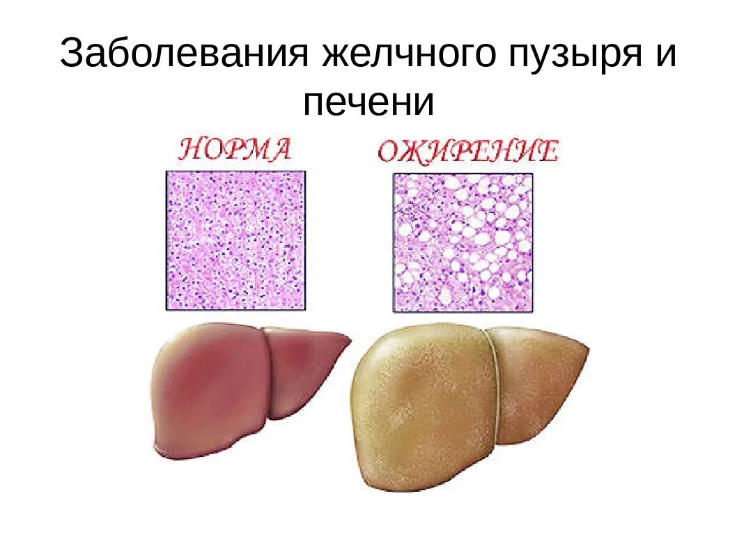 Жировая печень лечение народными средствами. Жировой гепатоз печени. Гепатоз ожирение печени.