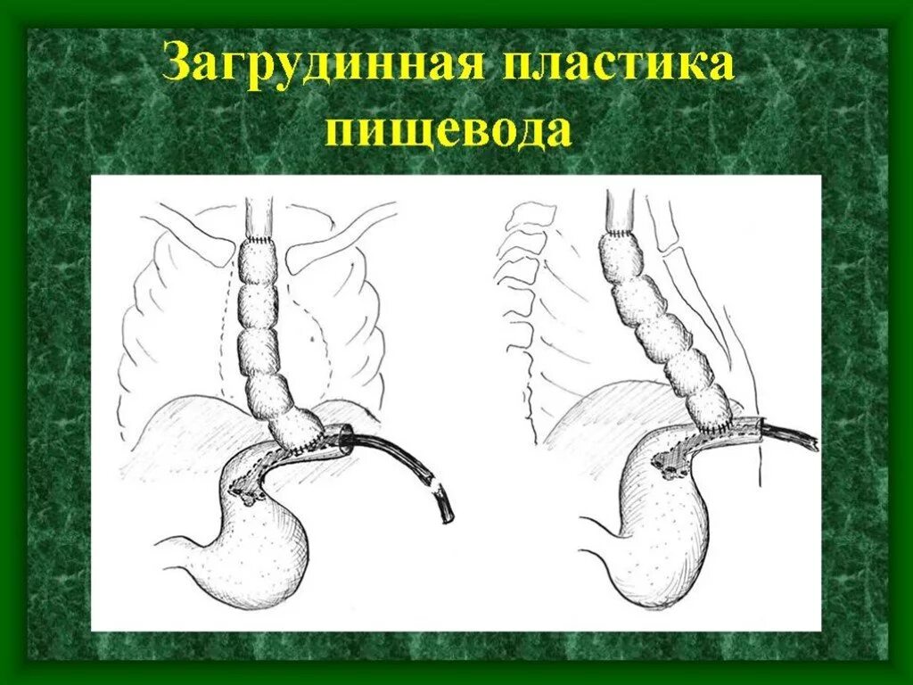 Развитие пищевода