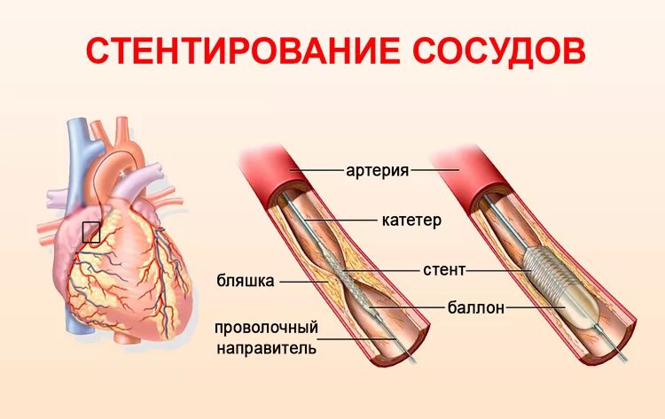 3 стента