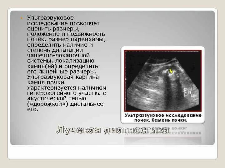Нефроптоз почек степени. Нефроптоз почки 1 степени. Наиболее частые осложнения нефроптоза:. Определить подвижность почек у ребенка. Подвижность почки.
