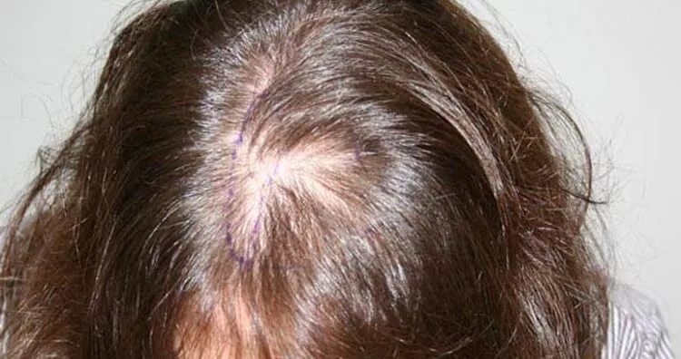 Симптомы алопеции. Андрогенная алопеция алопеция. Телогеновая алопеция волос. Диффузная телогеновая алопеция.