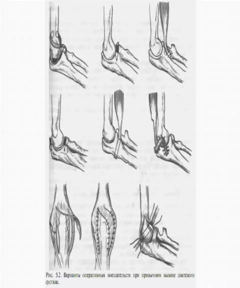 Вправление вывиха головки лучевой кости у детей. Подвывих локтевого сустава у ребенка. Вывих локтевого сустава рентген. Подвывих локтевого сустава рентген. Подвывих головки лучевой кости у детей.