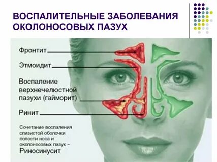 Лечение носовых пазух