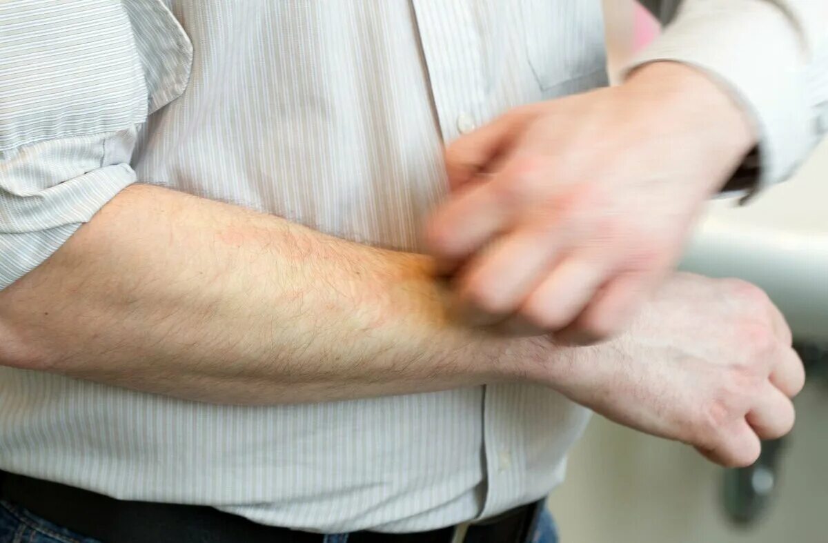 Отрубевидный лишай дерматология. Крем диадерм для ног показания. Зуд кожи при сахарном диабете 2 типа. Мази для диабетиков от зуда. Экзема импетигинозная.