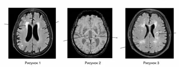 Хроническая ишемия головного мозга мрт. Хроническая ишемия головного мозга на кт. Хроническая ишемия головного мозга на кт и мрт. Лейкоареоз головного мозга мрт. Ишемические изменения мозга