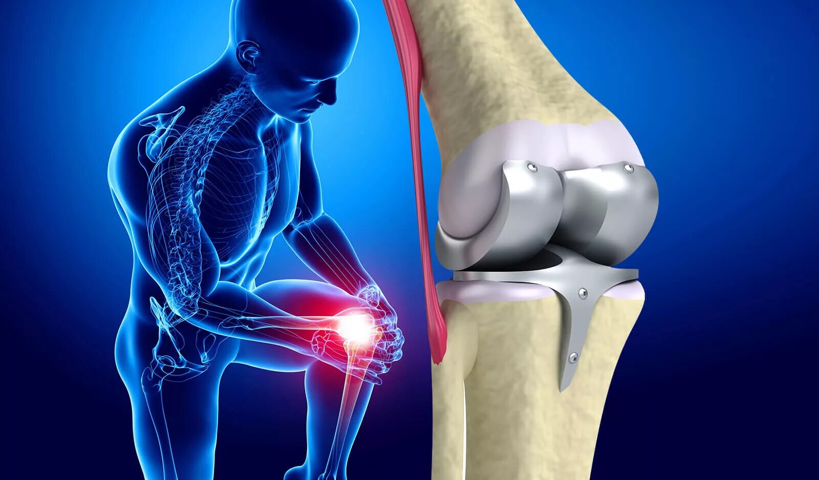 Эндопротезирование суставов травматология. Эндопротез коленного сустава. Артропластика коленного сустава. Эндопротезирование коленного Stryker.