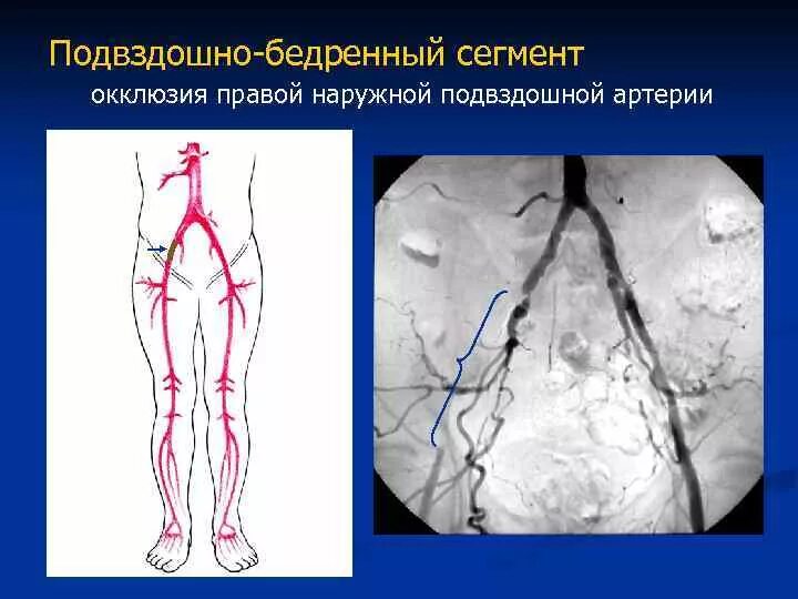 Тромбоз бедренной артерии ангиография. Атеросклероз бедренной артерии рентген. Облитерирующий атеросклероз сосудов ног. Облитерирующий атеросклероз бедренной артерии. Окклюзионный тромбоз