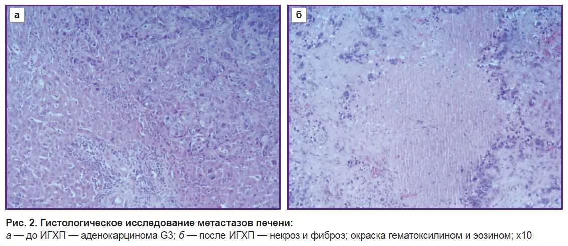 Алкогольная болезнь печени мкб 10. Метастазы печени мкб 10. Жкб код по мкб 10. Мкб-10 международная классификация болезней коды онкология. Желчекаменная болезнь код мкб 10.