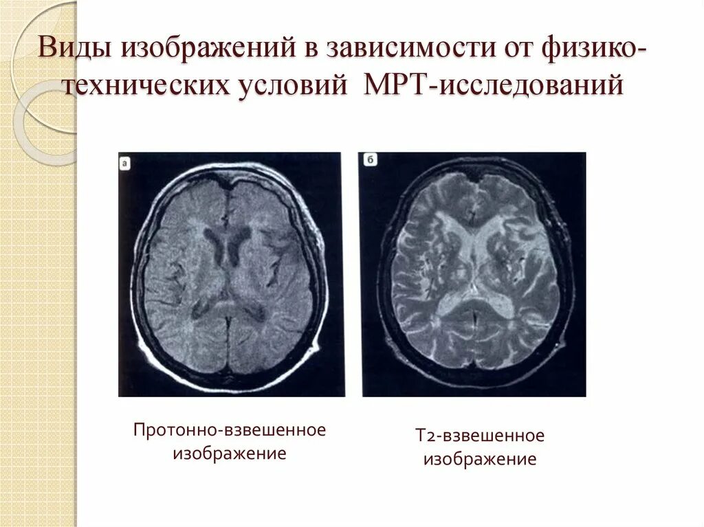 Взвешенное изображение мрт. Т1 и т2 изображения мрт. т1 и т2 взвешенные изображения в мрт. мрт т1 и т2 режимы что это. t1 t2 мрт.