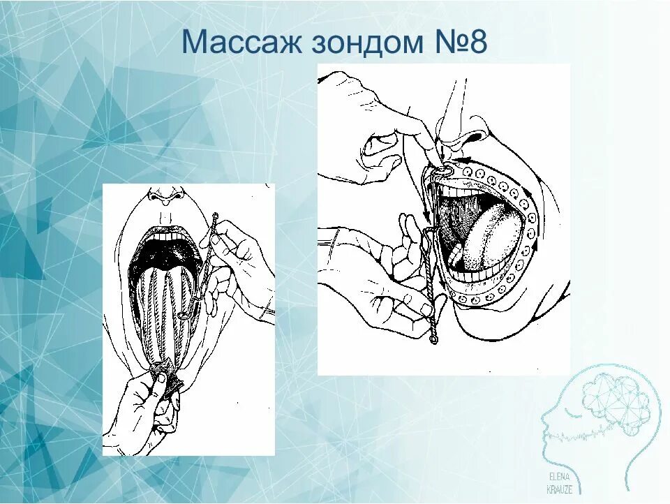 Массаж зондами. Зондовый логопедический массаж. Зонд для массажа языка. Зонды для логопедического массажа. Зондовый массаж языка для детей.