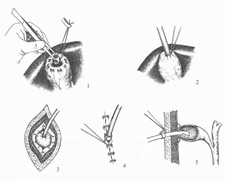Холецистостомия, холецистэктомия, холедохотомия. Дренаж после операции на желчных. Дренажный катетер желчного пузыря. Дренаж после операции на желчных. Катетер для дренирования желчного протока.