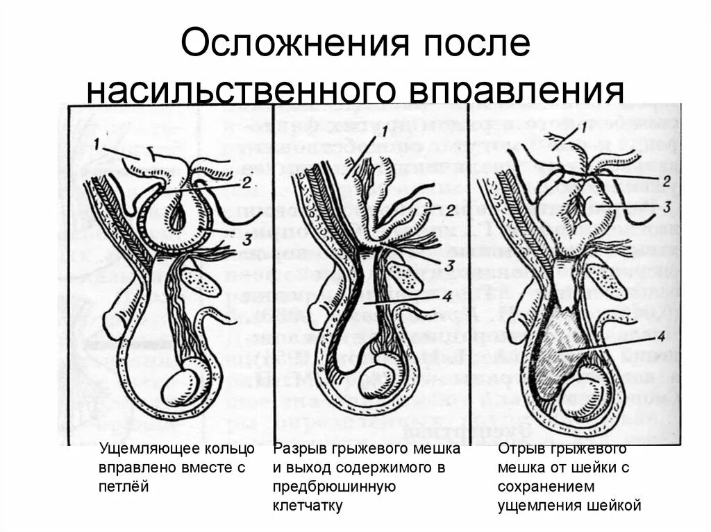 Осложнения при насильственном вправлении ущемленной грыжи. Мнимое вправление и ложное ущемление грыжи. Грыжа Брока мнимое ущемление. Возможность вправления ущемленной грыжи.