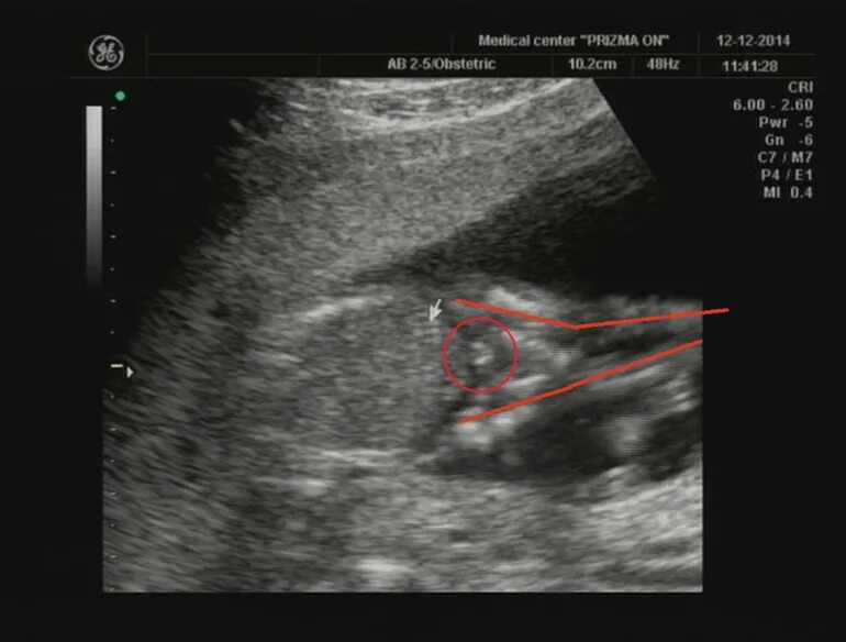 Как отличить на узи. Пол ребенка на УЗИ. Пол на УЗИ. На УЗИ видно пол ребенка. Как по фото УЗИ определить пол ребенка.