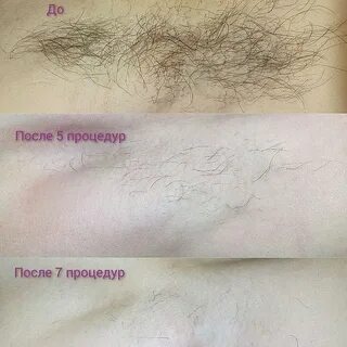 Нужно ли образование для электроэпиляции