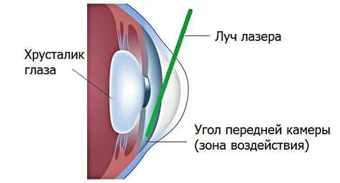 Лазерная операция при глаукоме