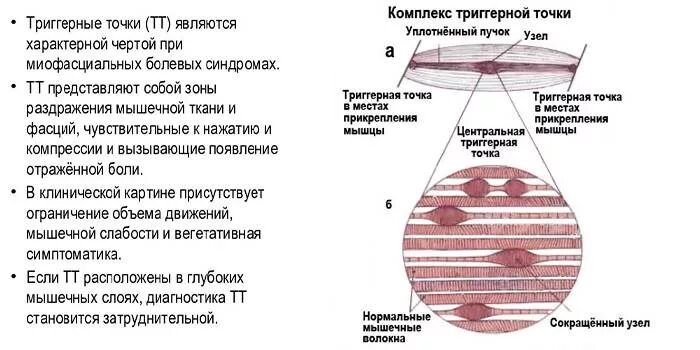 Как найти триггерную точку