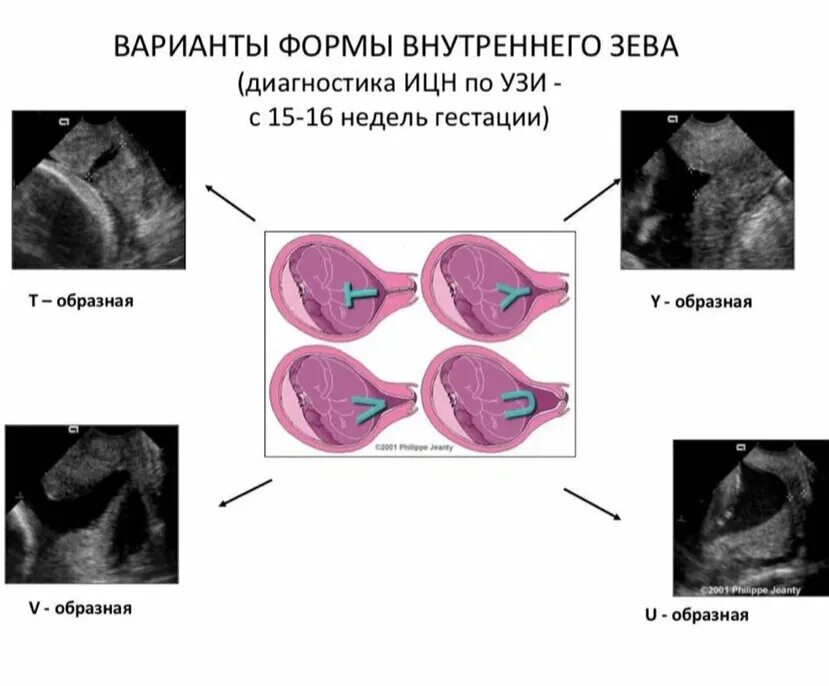 Ультразвуковые критерии ИЦН. Критерии истмико цервикальной недостаточности по УЗИ. V образное расширение внутреннего зева шейки матки при беременности. Y образная форма внутреннего зева.