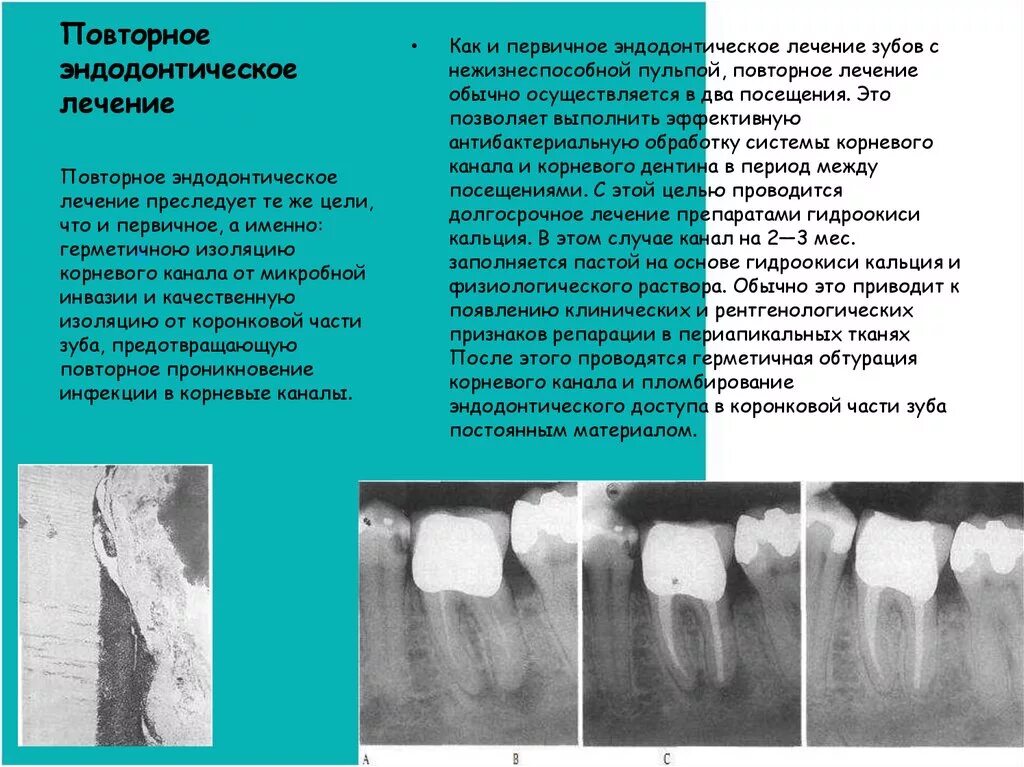 Восстановление после эндодонтического лечения. Эндодонтическое перелечивание зубов. Протокол обработки корневых каналов в молочных зубах. Эндодонтия корневых каналов этапы. Критерии оценки корневых каналов эндодонтия.