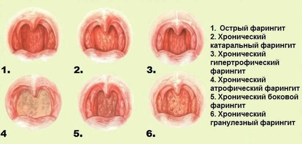 Формы хронического гипертрофического фарингита. Гипертрофический (гранулёзный) фарингит. Хронический фарингит факторы. Гипертрофический ларингит. Сокращение глотки