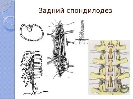 Спондилодез аутокостью
