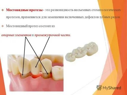 Промежуточные зубы