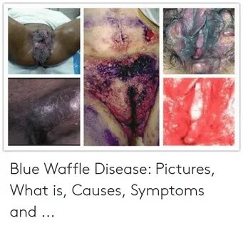 🐣 25+ Best Memes About Blue Waffle Disease Blue Waffle Disea
