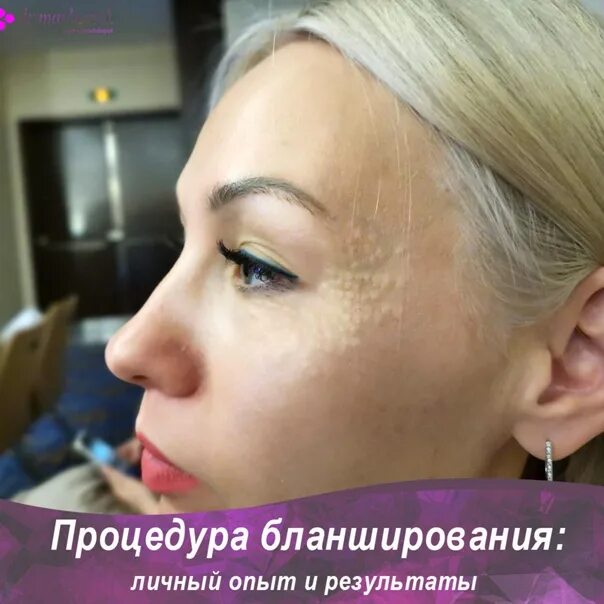 Бланширование лица до и после ТСА пилинг в Мелитополе 4 мастера Отзывы, Фото, Цена На дому
