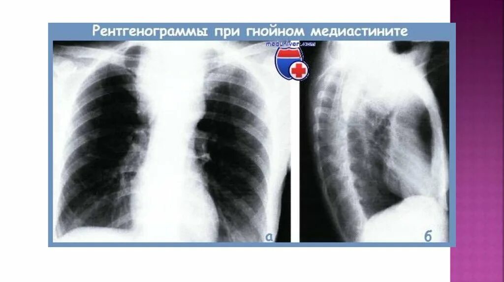 Медиастинит на рентгенограмме. Острый медиастинит рентген. Нисходящий некротизирующий острый медиастинит. Медиастинит рентгенологические признаки. Гнойный медиастинит