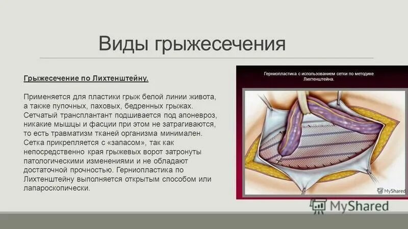 Пупочная грыжа у взрослых код по мкб. Паховая грыжа грыжесечение. Грыжесечение герниопластика по Лихтенштейну. Грыжесечение бедренной грыжи по Лихтенштейну. Паховая грыжа герниопластика.