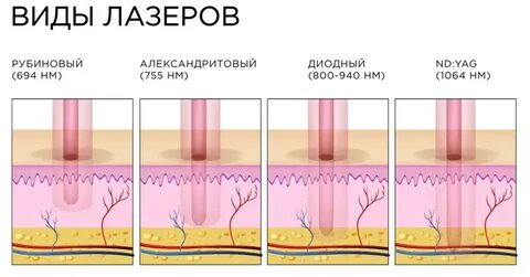 Лазерная эпиляция разница