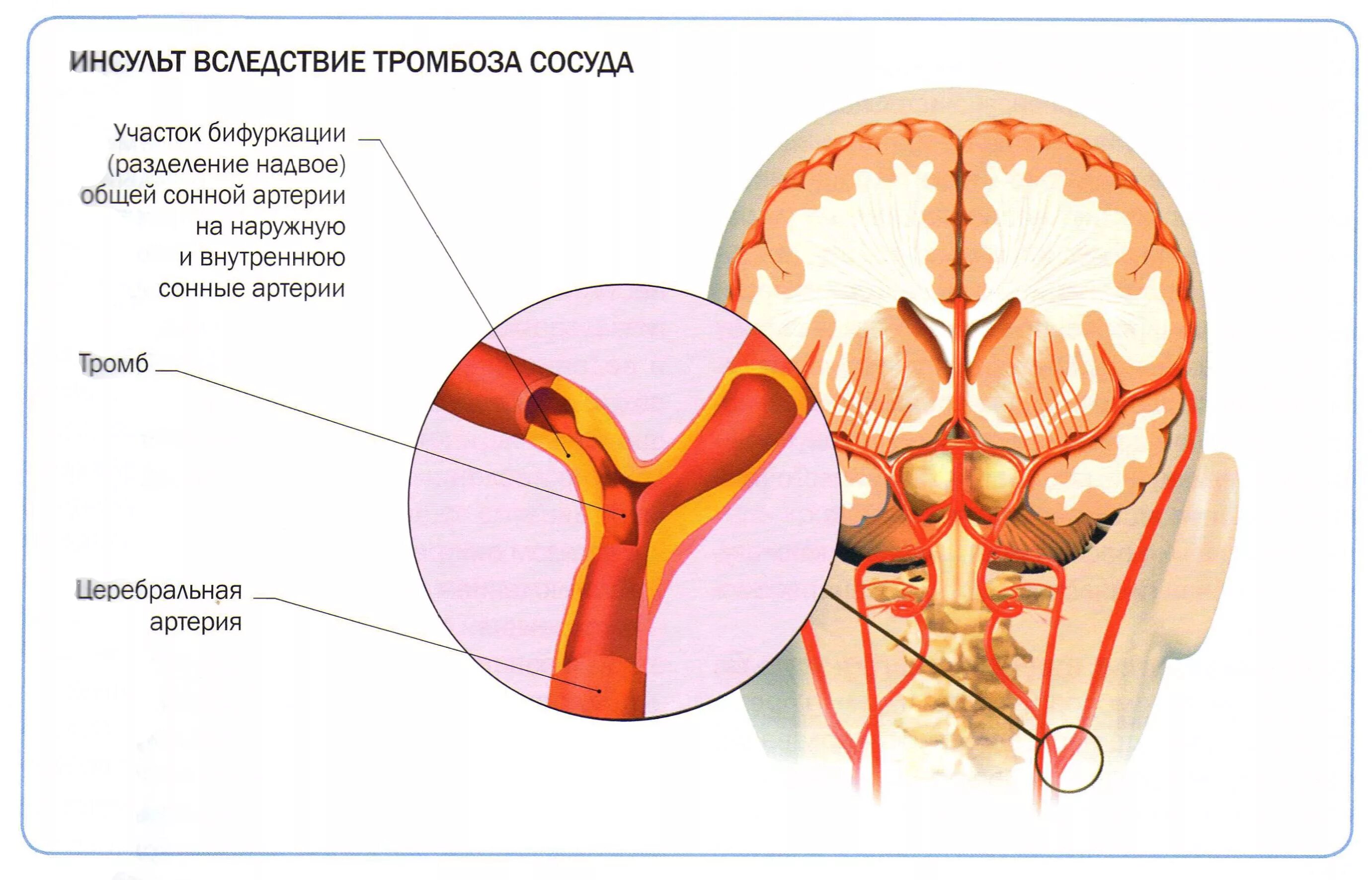 Церебрального тромбоза. Тромбоз лобной артерии. Тромбоз сонной артерии головного мозга. Тромботический ишемический инсульт. Тромбоз церебральных артерий.